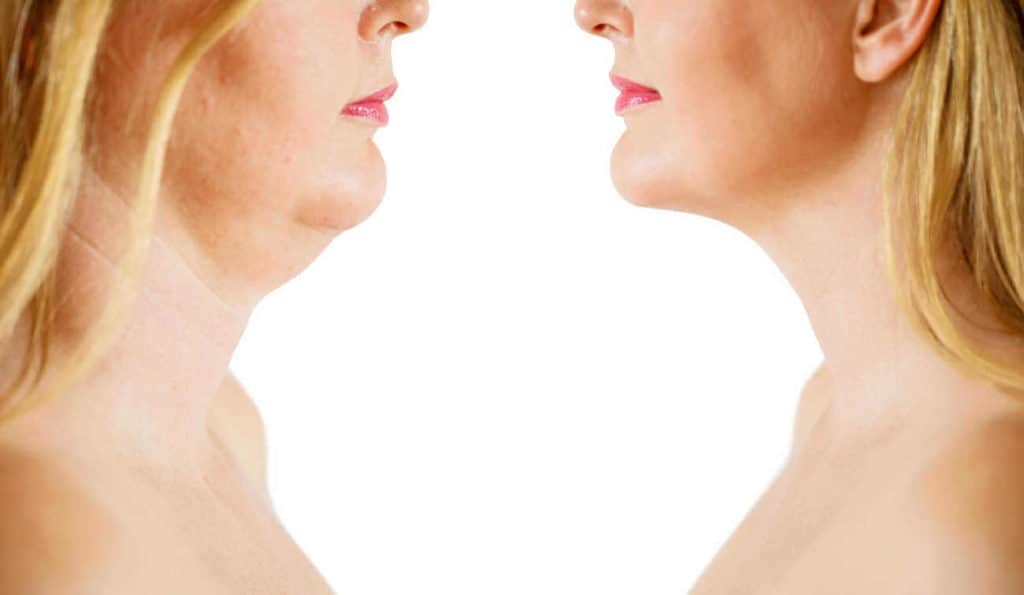 Double Chin treatment Lancashire before and after results
