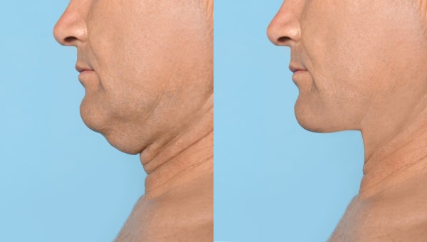 Which Non-Surgical Treatments Work Best for Jowls and Loose Skin Lancashire?