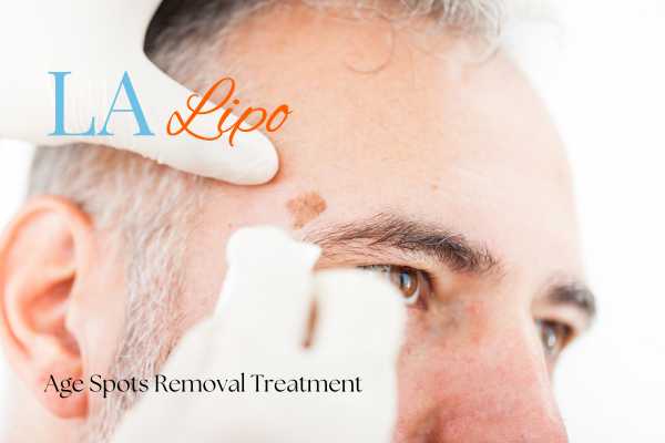 What Are the Most Effective Treatments for Age Spots Lancashire?
