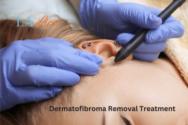 Dermatofibroma Removal Treatment Lancashire