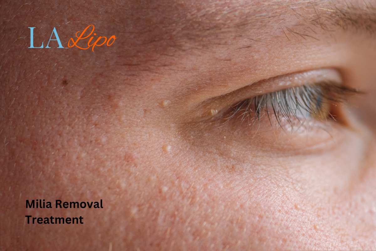Cryopen Milia Removal: Is It the Easiest and Safest Option Lancashire?