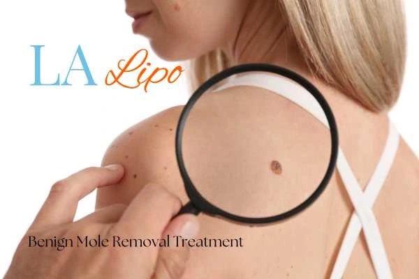 Woman having her inspection of blemish before mole removal Lancashire