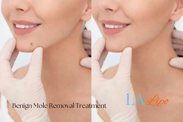 woman's before and after mole removal Lancashire results