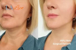 hi-fu for wrinkles Lancashire before and after results