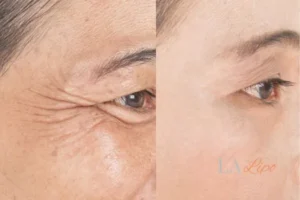 Before and after results of woman - HI-fu wrinkles reduction treatment Lancashire