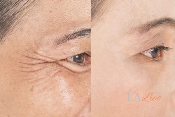 Before and after results of woman - HI-fu wrinkles reduction treatment Lancashire