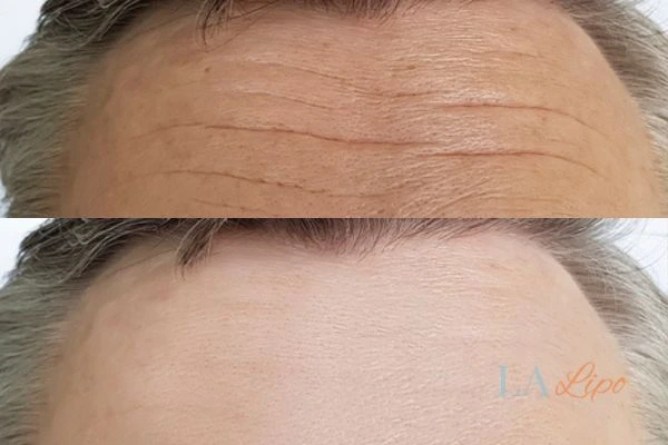results of HIFU Lancashire on mans forehead to help reduce lines and wrinkles