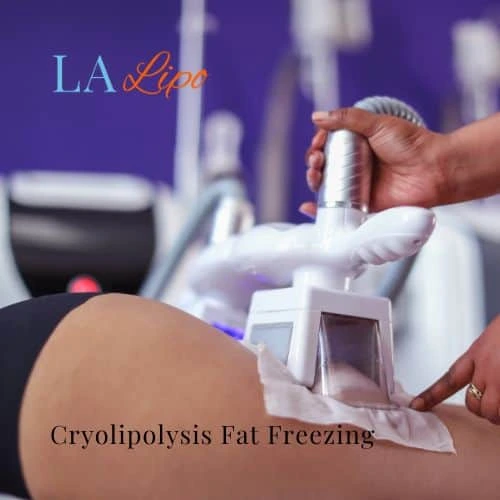 fat freezing - Cryolipolysis Lancashire