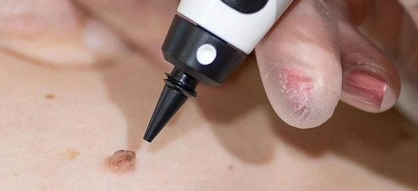 skin tag removal using cryopen Lancashire