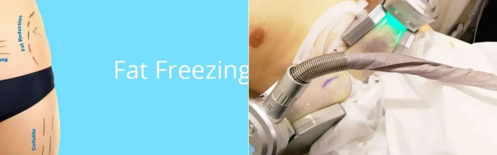 Fat freezing Lancashire on multiple areas of the body