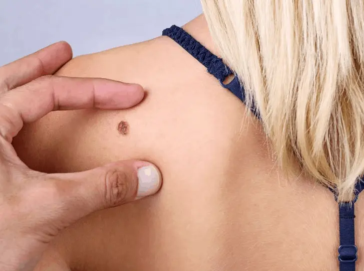 woman having mole removal Lancashire consultation before treatment.