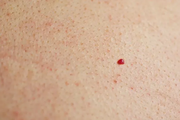 close up of a cherry angioma Lancashire