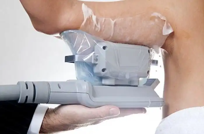 Picture of fat freezing Lancashire on the upper arms.