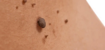 image of a skin tag Lancashire
