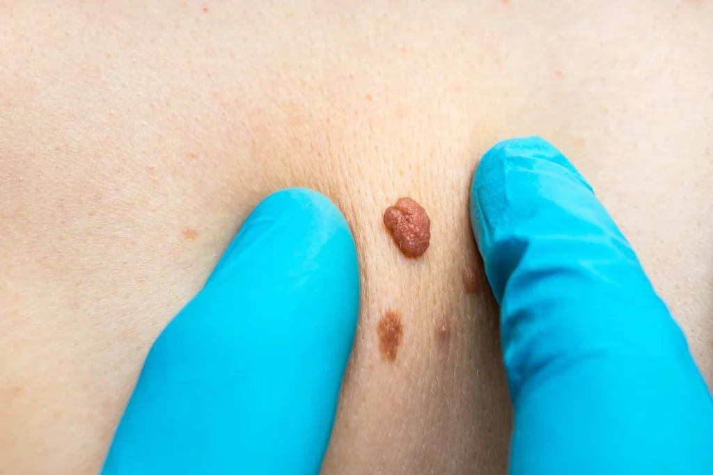 Consultant examining a skin tag Lancashire