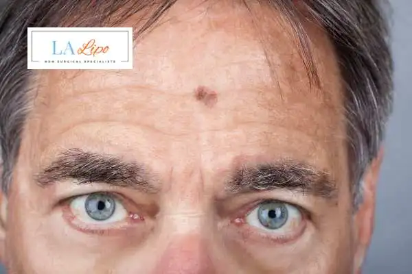 Solar Lentigo Removal Lancashire image of man with mark on his forehead