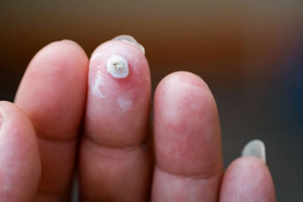 wart on person finger - cryotherapy to treat from LA LIPO Lancashire