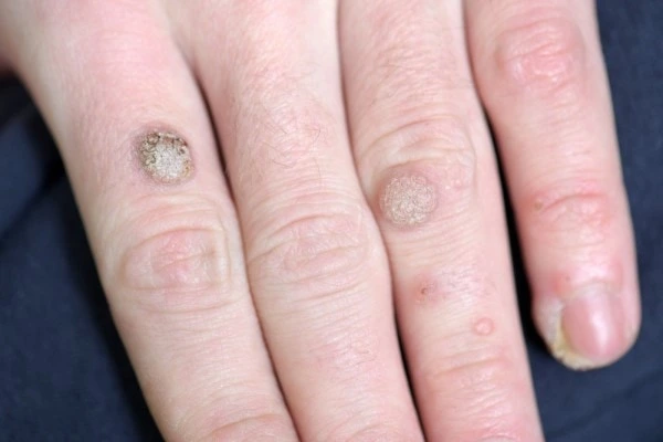 photo of warts on person hand - see wart removal Lancashire from LA LIPO