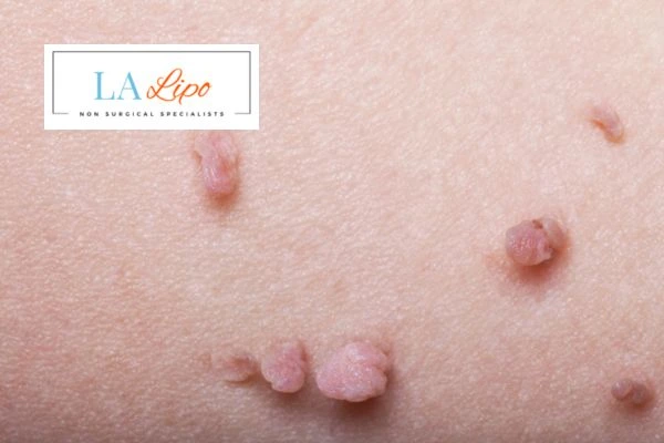 Does cryopen skin tag removal Lancashire hurt? Find out now call our team today!