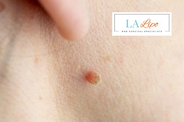 Book skin tag removal Lancashire today speak to our team now!