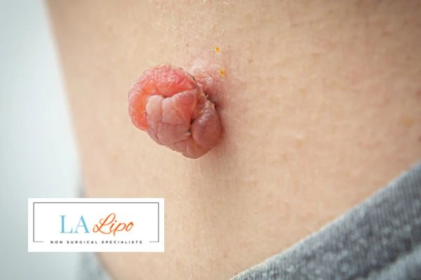 Interested in skin tag removal Lancashire? Concerned about the pain? Find out more today!