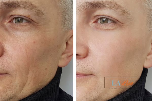 See the amazing results of Morpheus8 Treatment Lancashire!