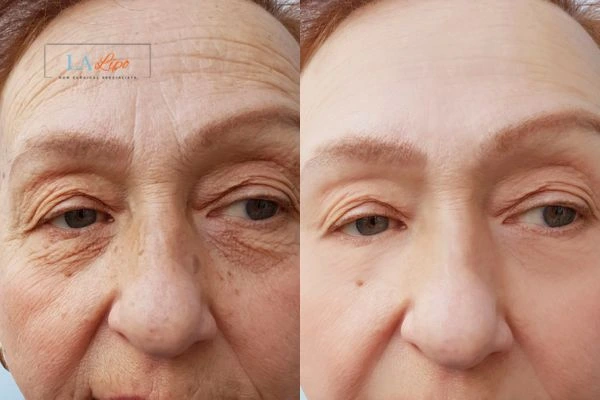 The powerful benefits of Morpheus8 Treatment Lancashire - Call Our team today!