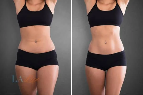 before and after results of non-surgical treatment to help a woman's body image and mental health Lancashire