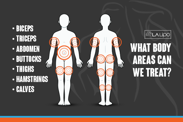 Diagram to show areas you can have LA-EMS Body Sculpting Treatment Lancashire