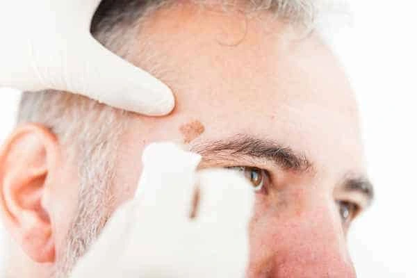 Age spots and elderly people Lancashire what is the link?