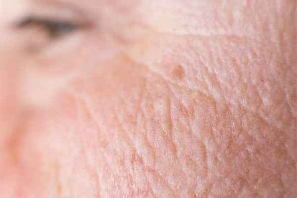 close up picture of a woman's face showing an age spot Lancashire