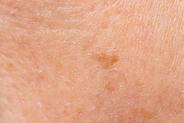 close up picture of age spots Lancashire