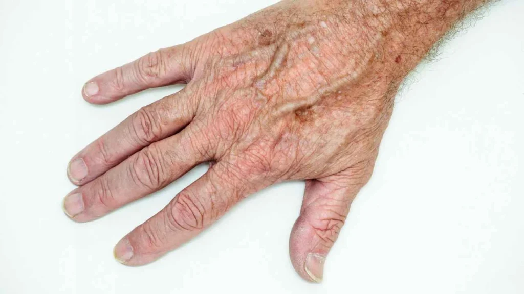 Male hand showing age spot Lancashire