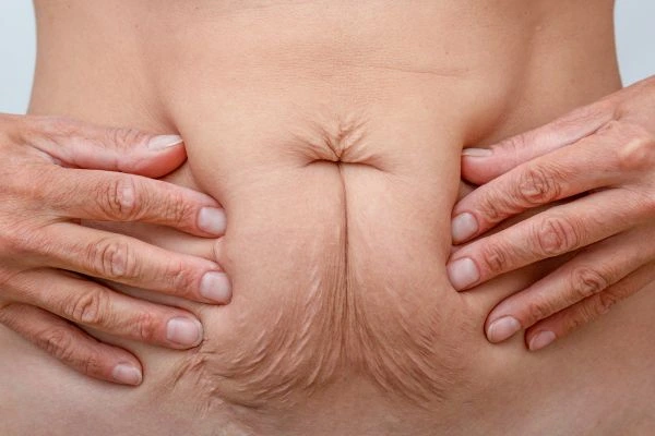 Image of a woman's stomach with loose skin - example of skin tightening Lancashire options