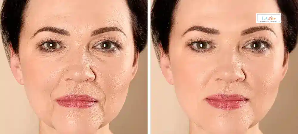 How Long Does It Take to See Results and How Long Do They Last Lancashire?
