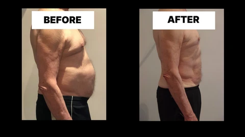 What Symptoms Can Diastasis Recti Cause in Men? Weak Core, Back Pain and Poor Posture Lancashire